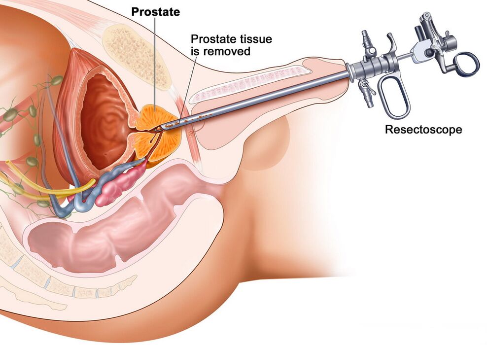Eesnäärmekoe kogumine prostatiidi täpseks diagnoosimiseks